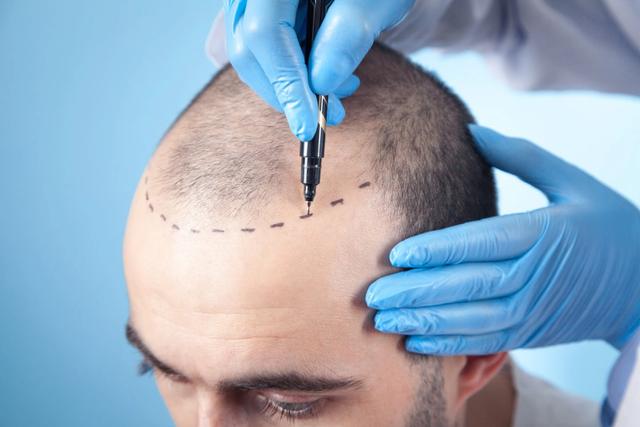 Hair transplant