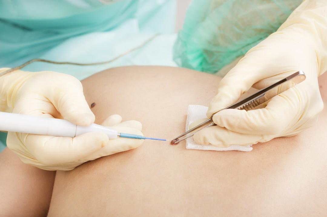 Electrocautery/ RF
