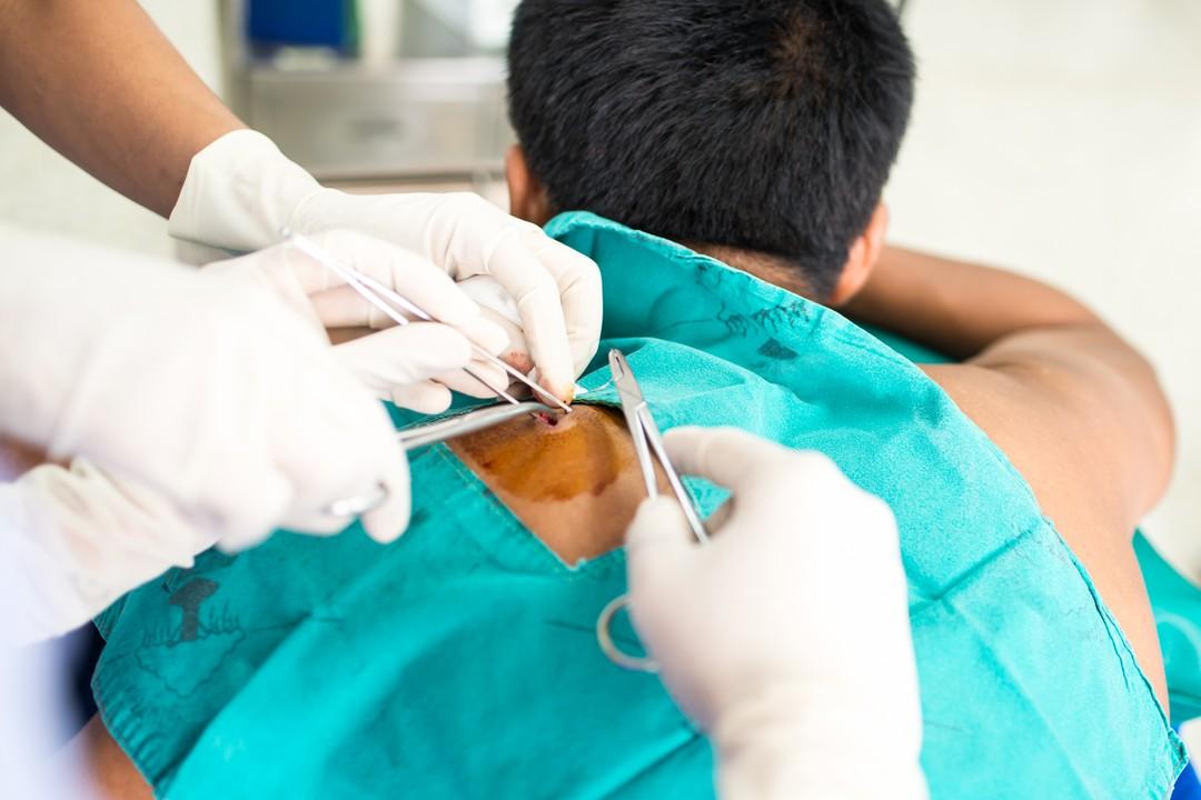 Cyst removal