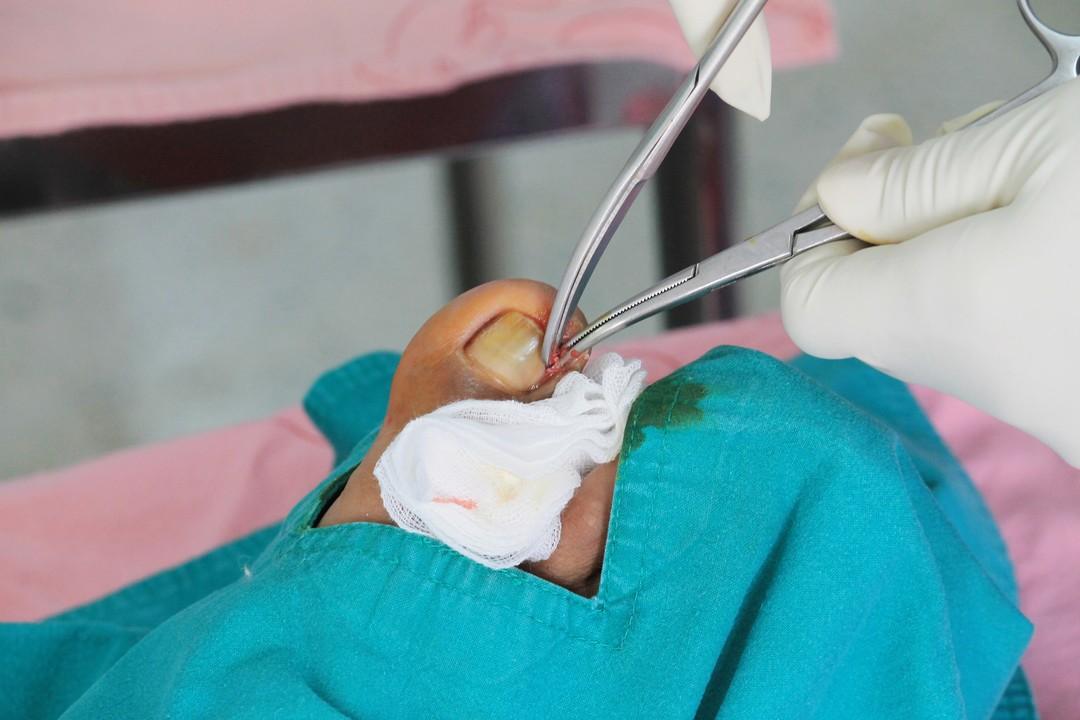 Nail surgery