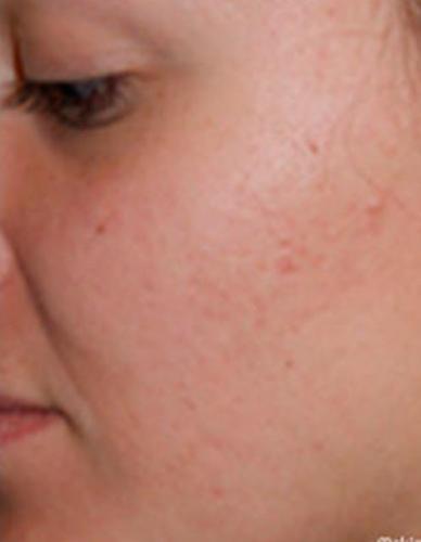 after treatment after treatment