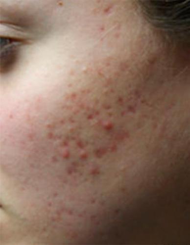 before treatment before treatment