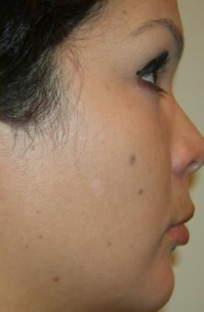 after treatment after treatment