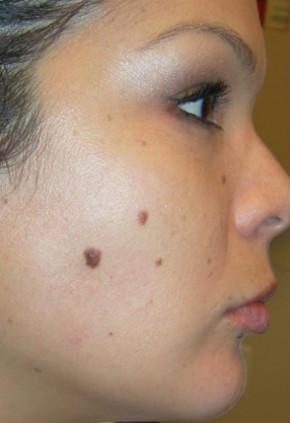 before treatment before treatment