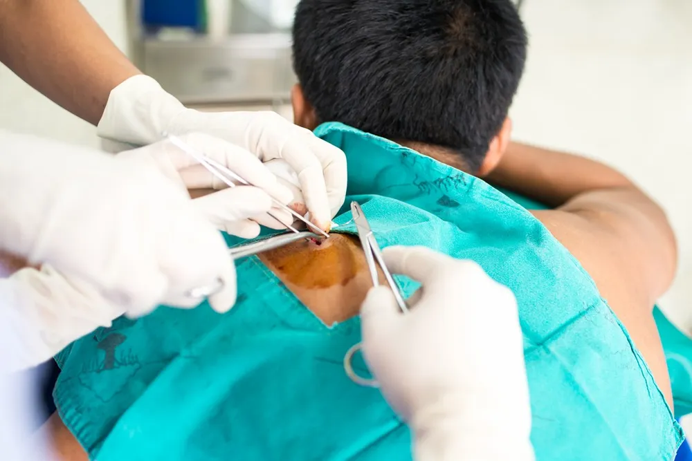 Cyst Removal
