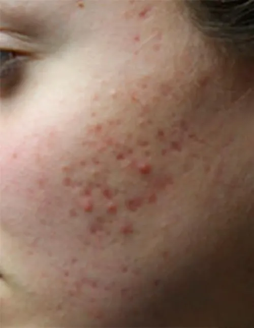 before treatment before treatment