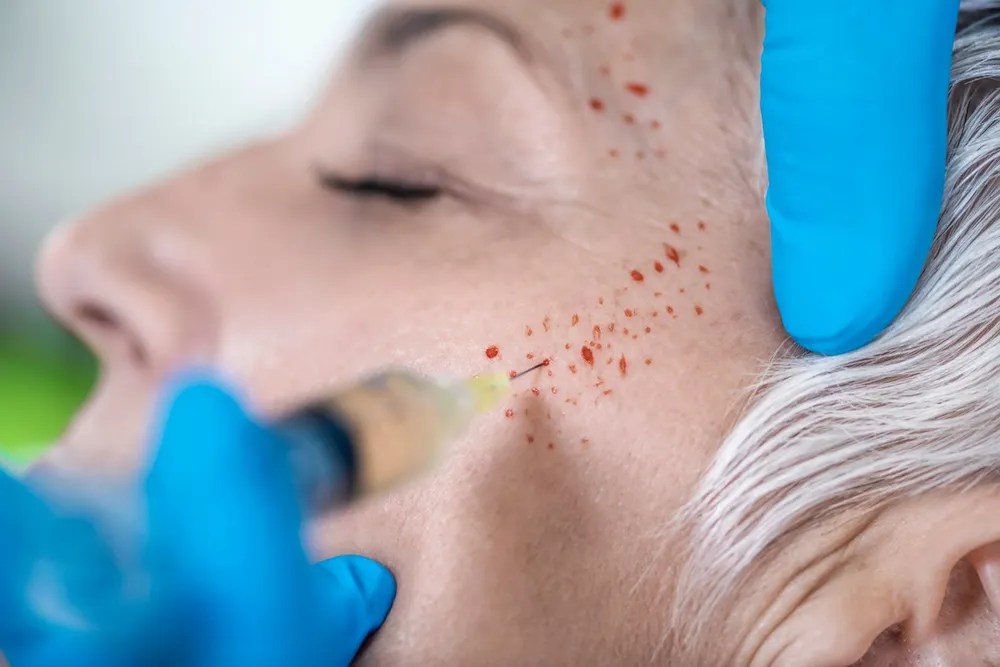 Mesotherapy for Scalp