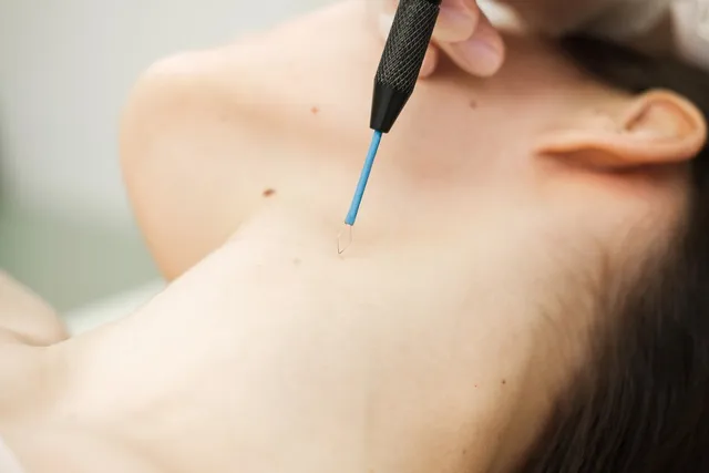 Mole Removal