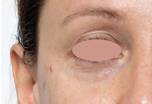 after treatment