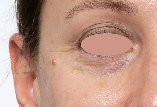 before treatment