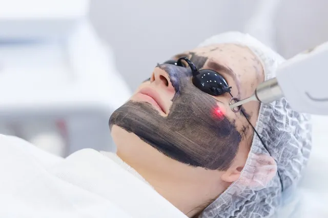Q-Switched Nd:YAG Laser