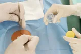 Skin Biopsy