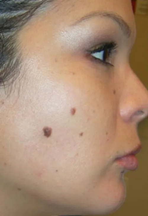 before treatment before treatment